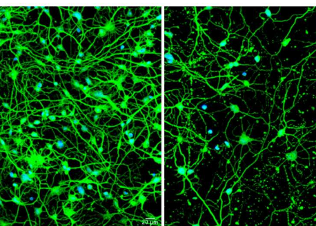 由亨廷顿病患者皮肤细胞制成的神经元揭示认知衰退