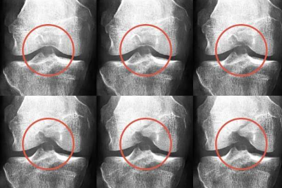 人工智能生成的 X 射线图像欺骗了医学专家并改进了骨关节炎分类