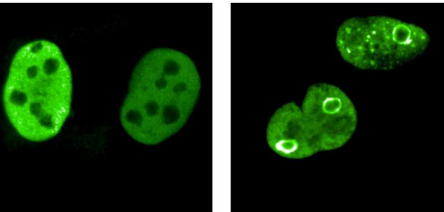蛋白质球保护癌细胞的基因组