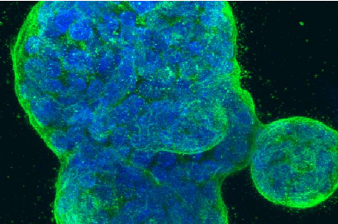 研究人员发现可以预测化疗敏感性的乳腺癌蛋白