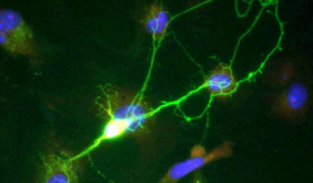 研究发现源自干细胞的神经元可预测精神分裂症患者的精神病和认知缺陷