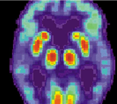 抗精神病药物与阿尔茨海默病患者的脑损伤有关