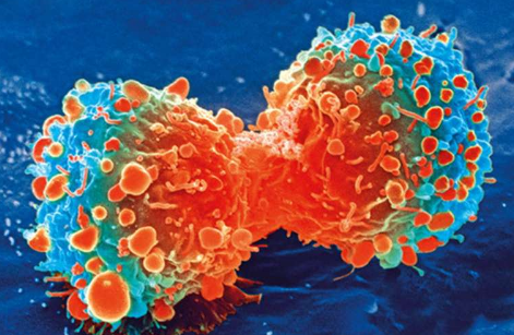 研究表明乳酸可能会促进癌症形成